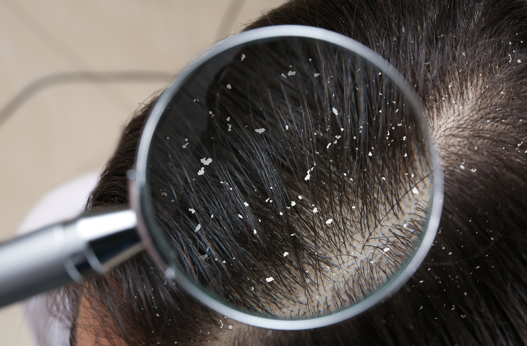 Closeup of Woman with Dandruff in Her Hair, View through Magnify
